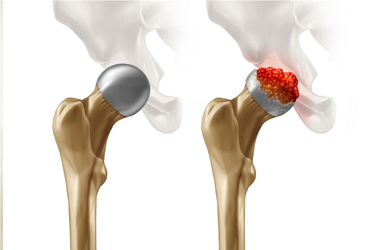 AVN-Cultured-Osteoblast