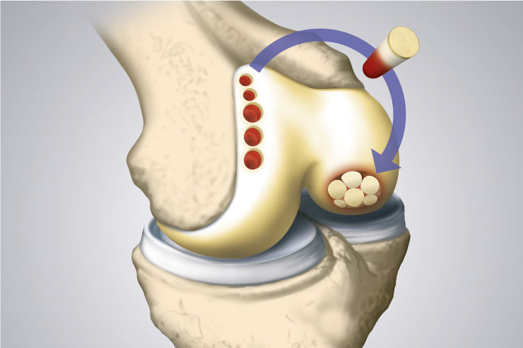 Cartilage-Transplantation