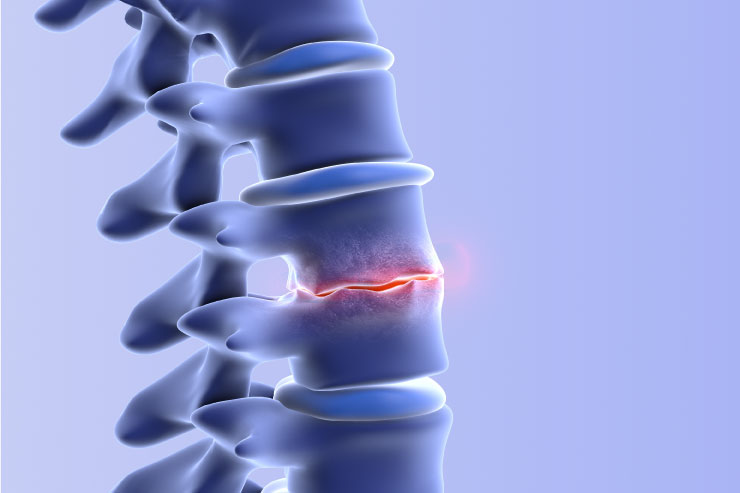 Degenerative-Disc-Surgery